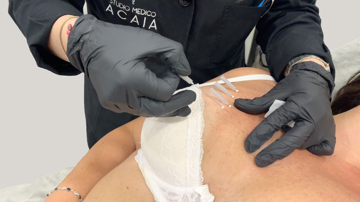 Soft lifting non chirurgico con fili