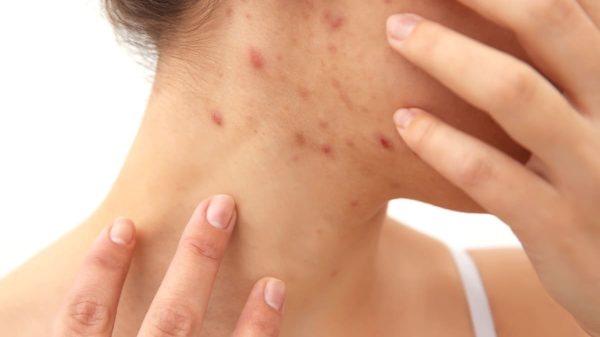 come curare la psoriasi
