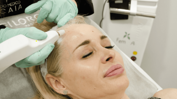 macchie viso laser