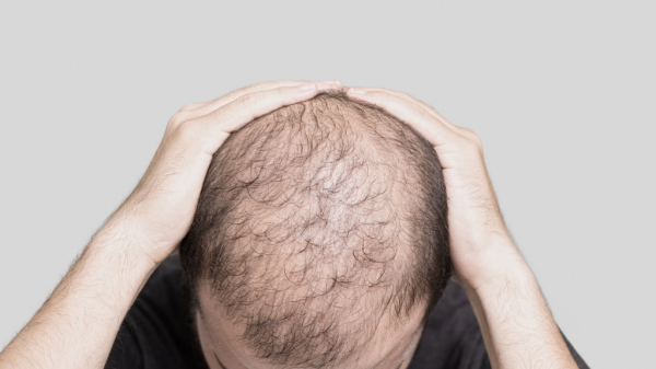 tricopigentazione capelli