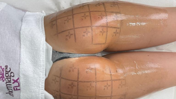 thermage glutei